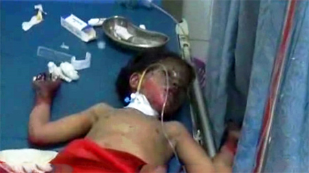 una niña victima de la agresión saudí en Yemen Zonas residenciales en Yemen, objetivos de la agresión de los Saud