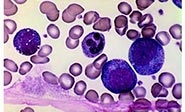 Convierten células de c&#225;ncer en inofensivos gl&#243;bulos blancos