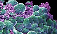 Cient&#237;ficos iran&#237;es desarrollan un medicamento para combatir el c&#225;ncer